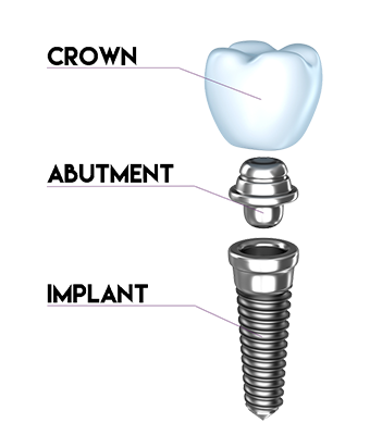 Dental Implant Illustration