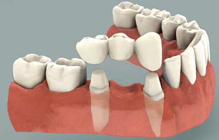 Dental Bridge Illustration