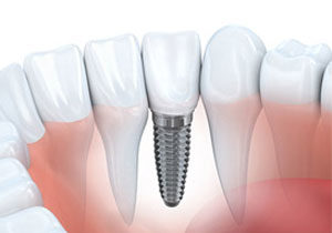 Single Tooth Replacement Single Tooth Replacement