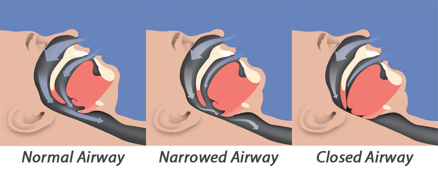 Sleep Apnea Illustration