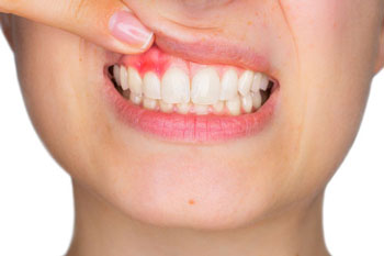 Inflamed Gums