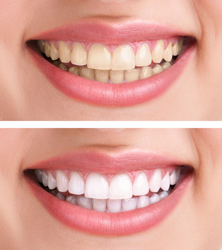 Teeth Whitening Before After